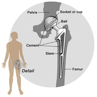 Schematic diagram of a hip prosthesis.