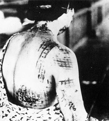 Atomic bomb injuries.