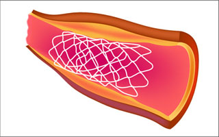 Medical stents keep hollow structures in the body open.